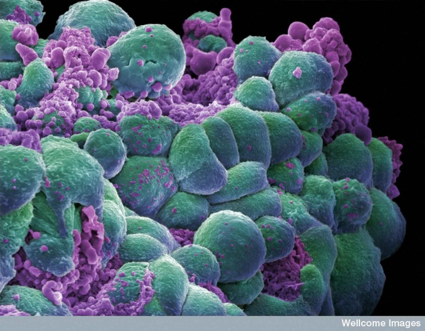 In this image, cancerous mammary cells have begun a process known as apoptosis, or programmed cell death.