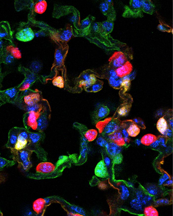 UK researchers make cytokine work for benefit of shrinking NSCLC tumors. UK researchers make cytokine work for benefit of shrinking NSCLC tumors.