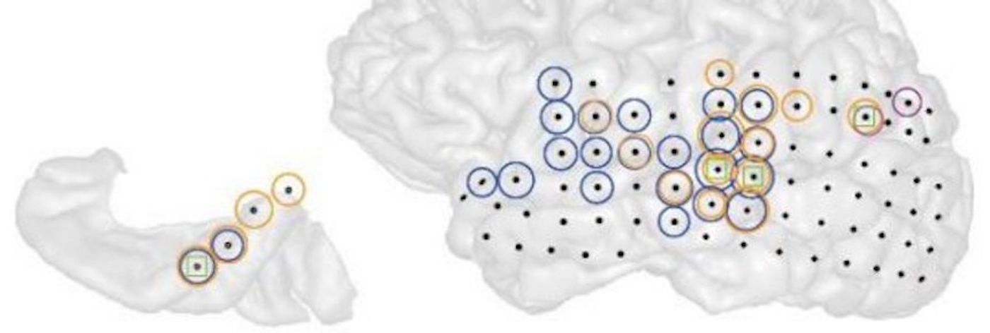 3-D image of the left hemisphere of a patient with tinnitus (right). Black dots indicate all the sites recorded from. Colored circles indicate electrodes at which the strength of ongoing brain activity correlated with the current strength of tinnitus perceived by the patient. Different colors indicate different frequencies of brain activity (blue = low, magenta = middle, orange = high).