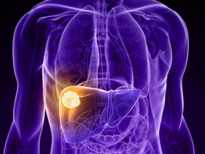 Liver cancer is usually found in already damaged cells.