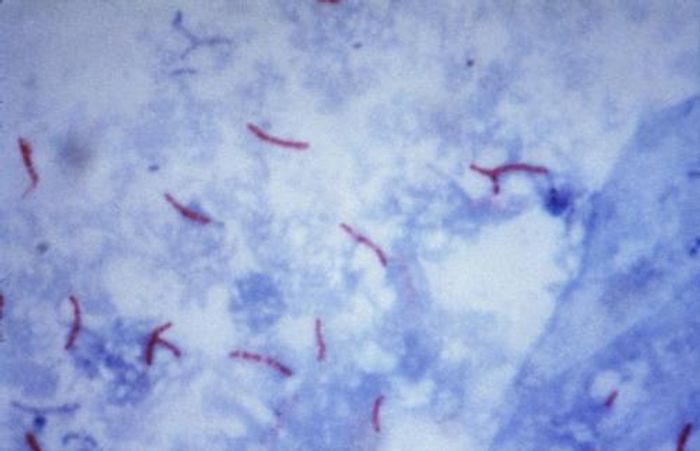 This photomicrograph reveals Mycobacterium tuberculosis bacteria using acid-fast Ziehl-Neelsen stain; Magnified 1000 X. The acid-fast stains depend on the ability of mycobacteria to retain dye when treated with mineral acid or an acid-alcohol solution such as the Ziehl-Neelsen, or the Kinyoun stains that are carbolfuchsin methods specific for M. tuberculosis. This photomicrograph reveals Mycobacterium tuberculosis bacteria using acid-fast Ziehl-Neelsen stain; Magnified 1000 X. The acid-fast stains depend on the ability of mycobacteria to retain dye when treated with mineral acid or an acid-alcohol solution such as the Ziehl-Neelsen, or the Kinyoun stains that are carbolfuchsin methods specific for M. tuberculosis.
