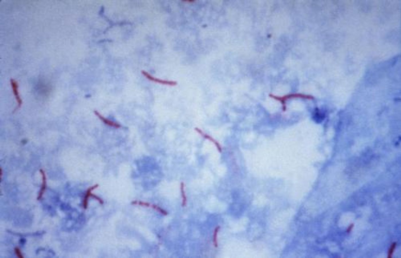 This photomicrograph reveals Mycobacterium tuberculosis bacteria using acid-fast Ziehl-Neelsen stain; Magnified 1000 X. The acid-fast stains depend on the ability of mycobacteria to retain dye when treated with mineral acid or an acid-alcohol solution such as the Ziehl-Neelsen, or the Kinyoun stains that are carbolfuchsin methods specific for M. tuberculosis.