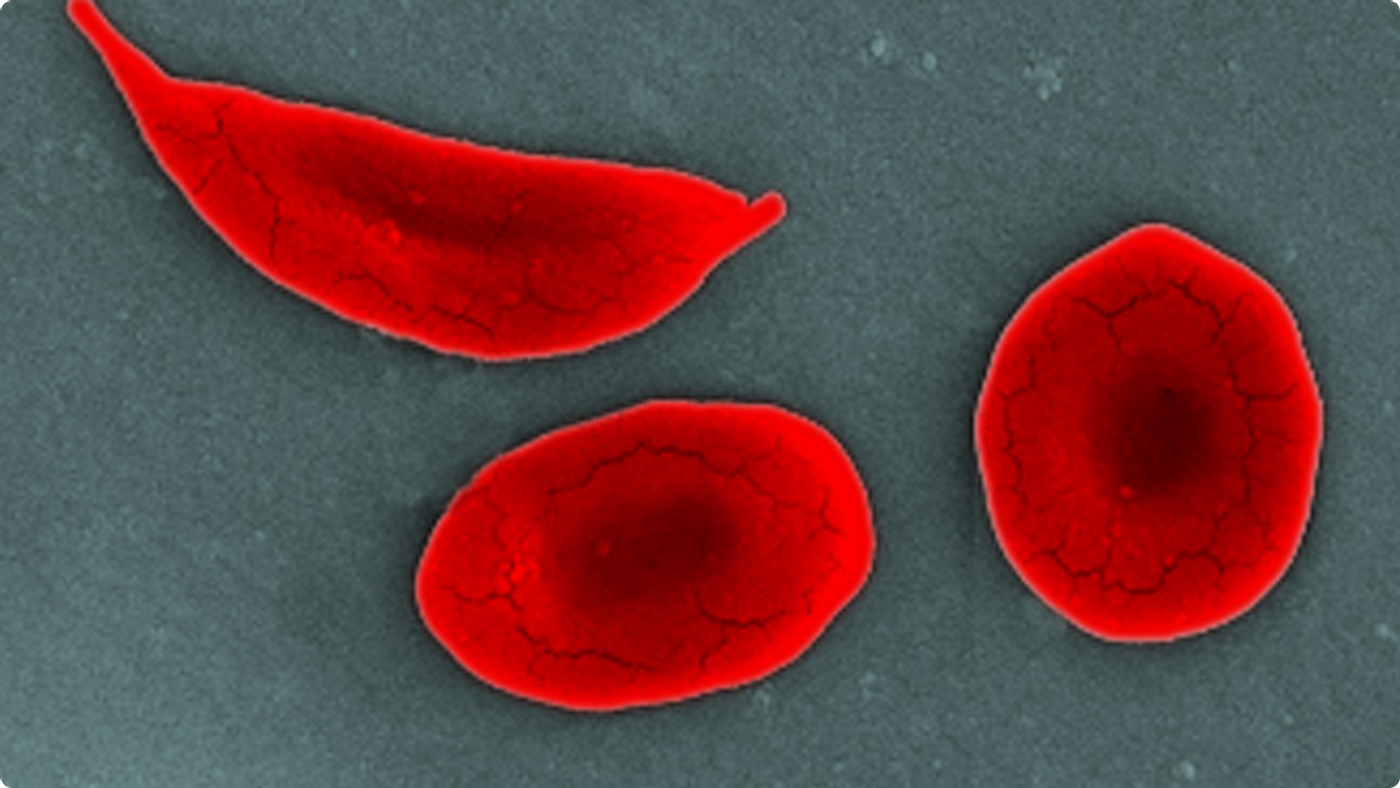 A sickle shaped red blood cell (top left) caused by SCD.