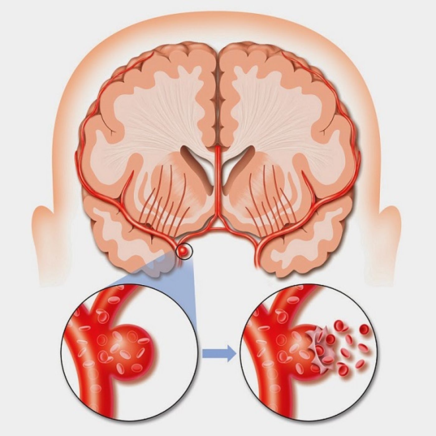 More work equals more likelihood of stroke.