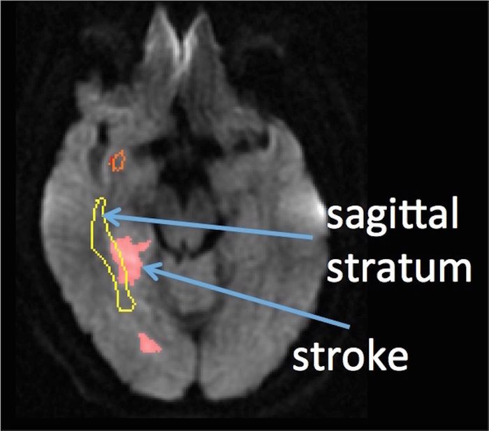 The area of the brain credited with recognizing sarcasm overlaps area impacted by stroke in test subjects. The area of the brain credited with recognizing sarcasm overlaps area impacted by stroke in test subjects.