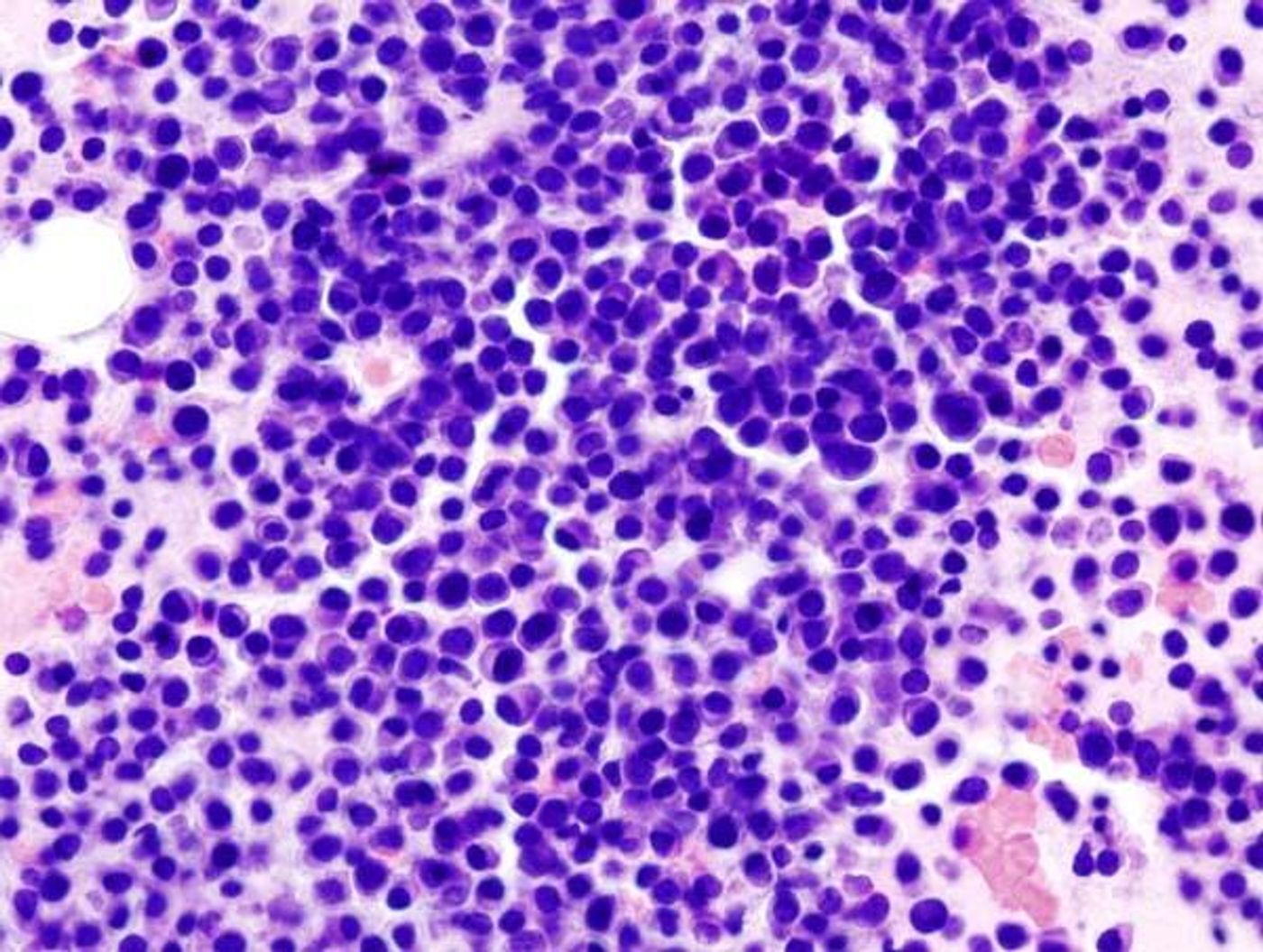 GBI Research says multiple myeloma market is growing.