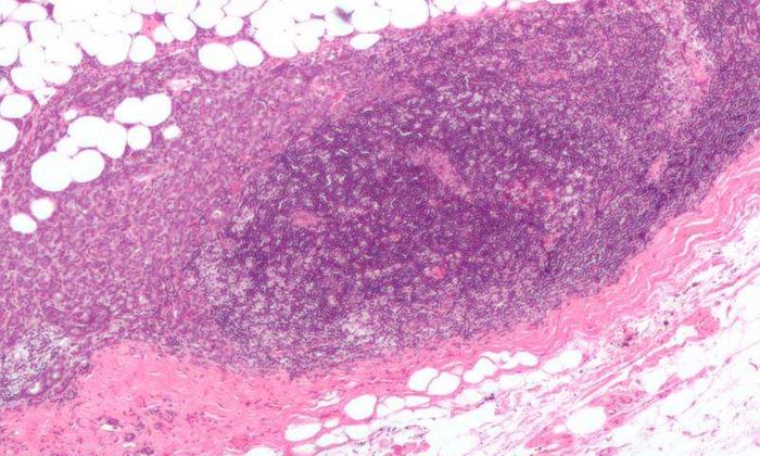 This micrograph shows a lymph node invaded by ductal breast carcinoma, with an extension of the tumor beyond the lymph node.