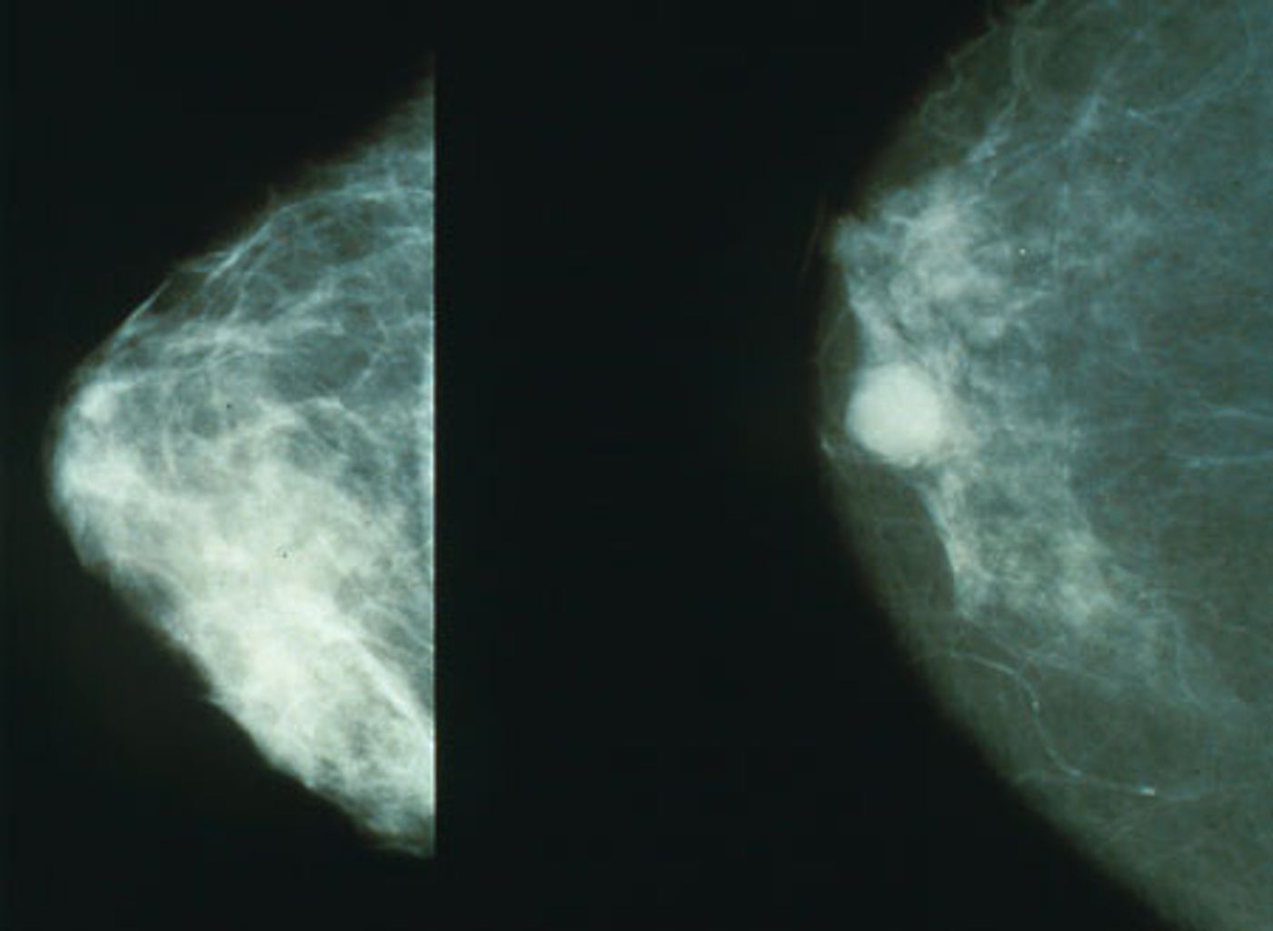 A few years ago, it was reported that breast cancer patients with a high number of immune cells called neutrophils in their blood are at increased risk of developing metastases. A few years ago, it was reported that breast cancer patients with a high number of immune cells called neutrophils in their blood are at increased risk of developing metastases.