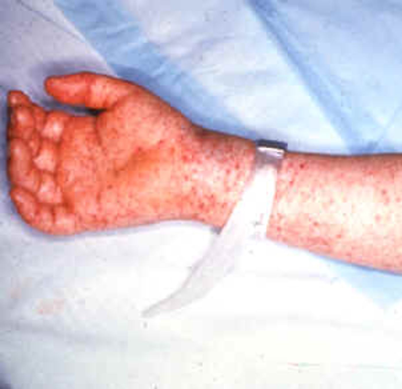 A rash typical of many cases of Rocky Mountain Spotted Fever