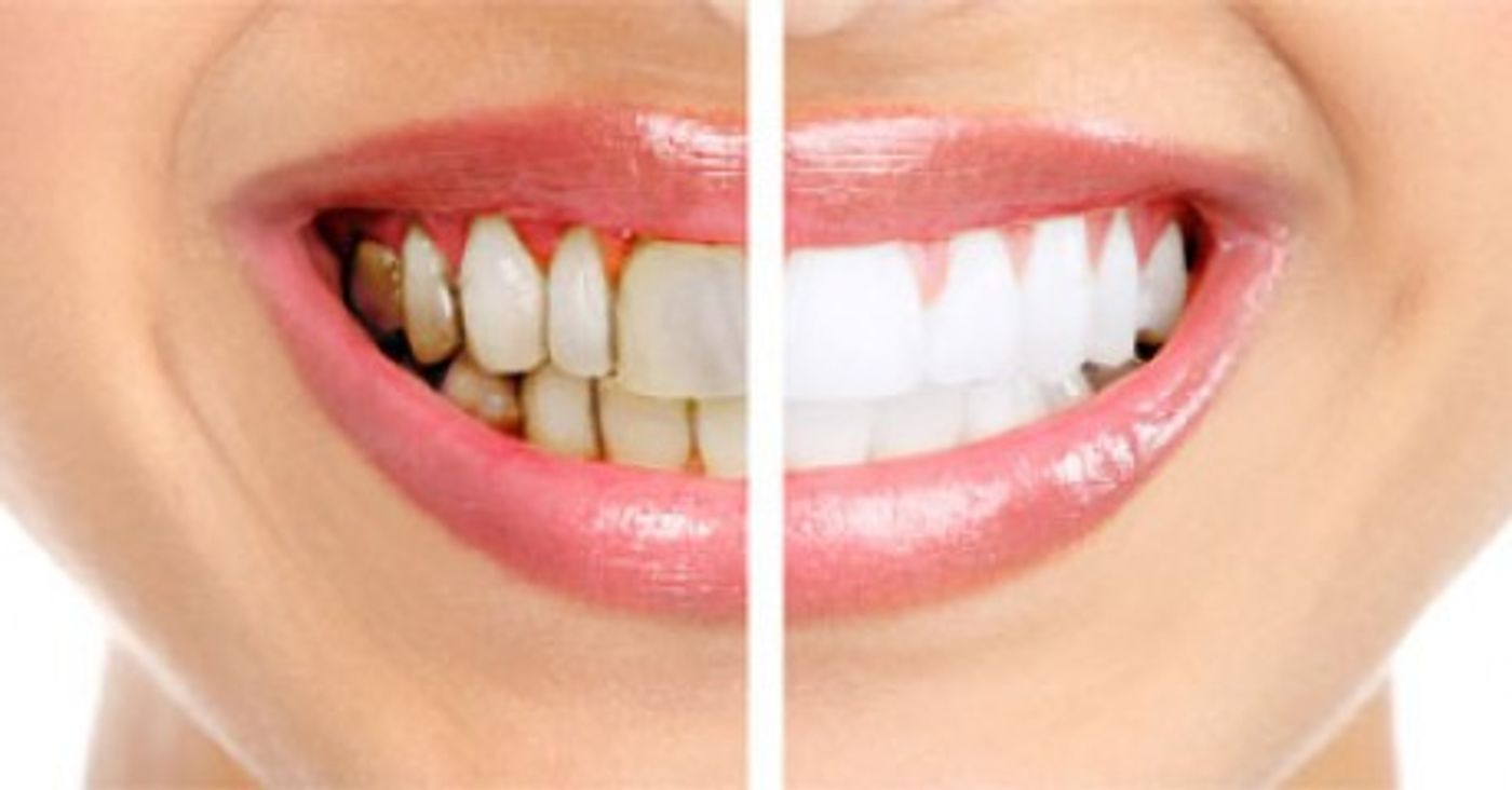 P. gingivalis causes gum disease (left).