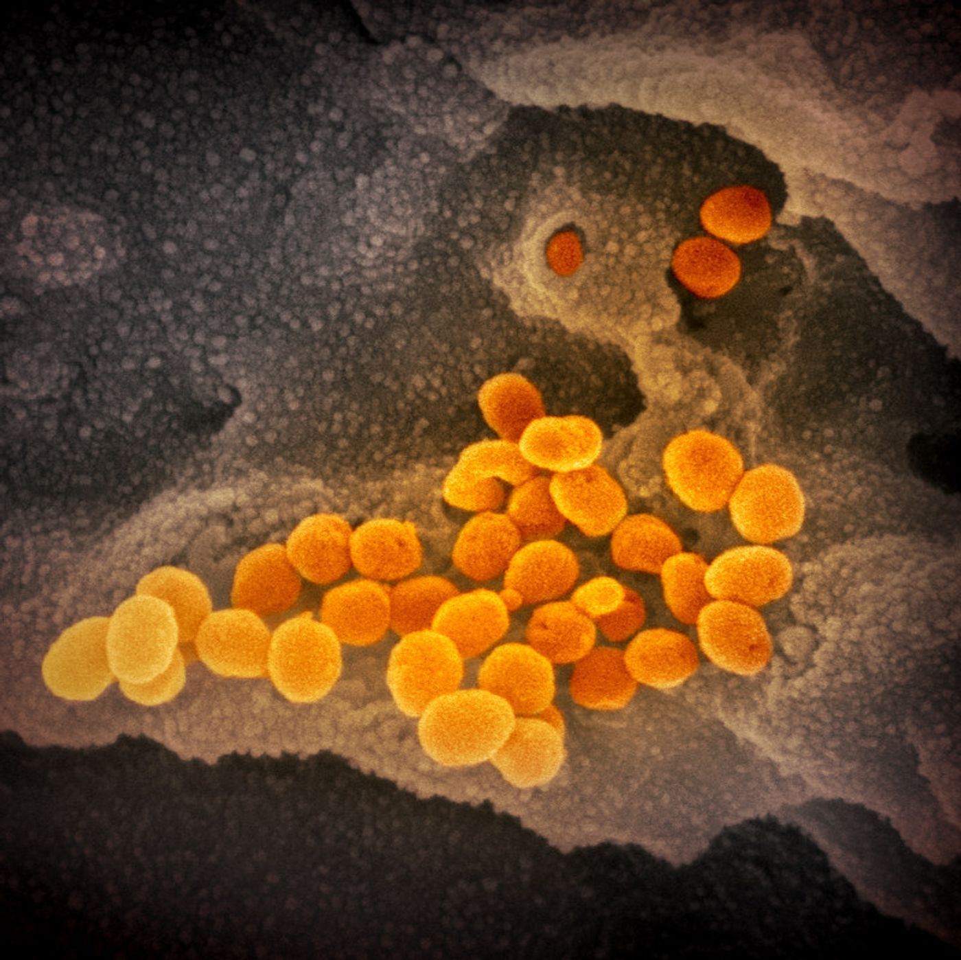 This scanning electron microscope image shows SARS-CoV-2 (orange)-also known as 2019-nCoV, the virus that causes COVID-19-isolated from a patient in the U.S., emerging from the surface of cells (gray) cultured in the lab. / Credit: NIAID-RML