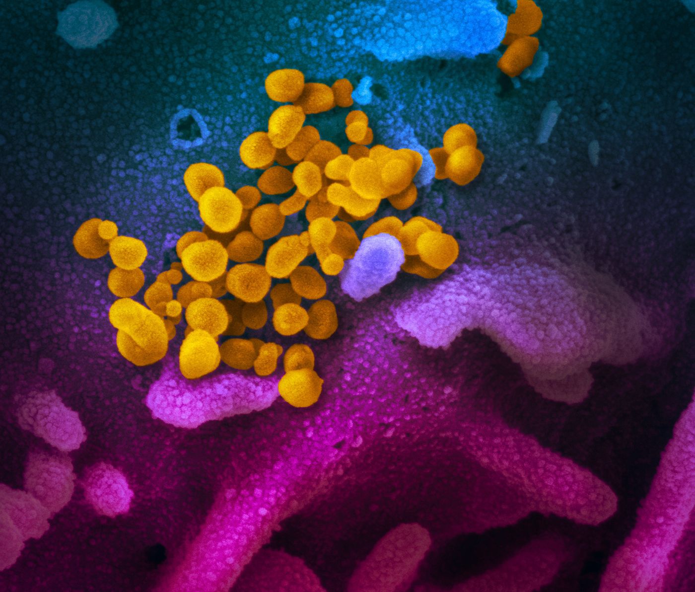 This scanning electron microscope image shows SARS-CoV-2 (yellow)-also known as 2019-nCoV, the virus that causes COVID-19-isolated from a patient in the U.S., emerging from the surface of cells (blue/pink) cultured in the lab. / Credit: NIAID-RML