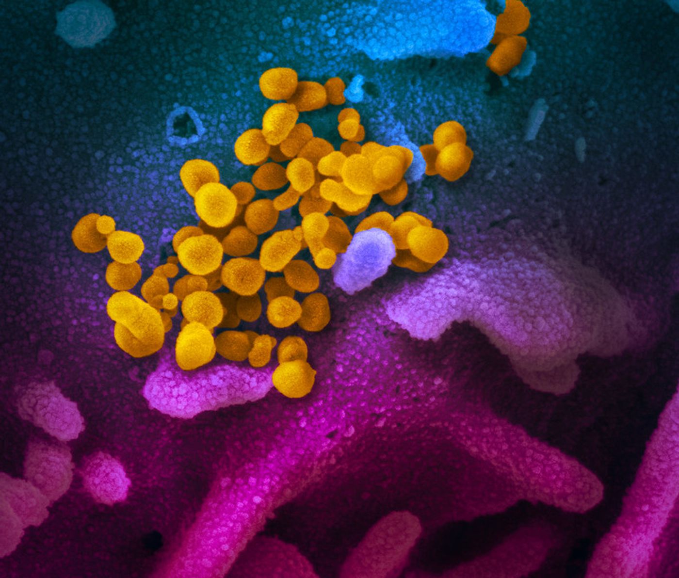   This scanning electron microscope image shows SARS-CoV-2 (yellow)-also known as 2019-nCoV, the virus that causes COVID-19-isolated from a patient in the U.S., emerging from the surface of cells (blue/pink) cultured in the lab.     Credit: National Institute of Allergy and Infectious Diseases-Rocky Mountain Laboratories, NIH