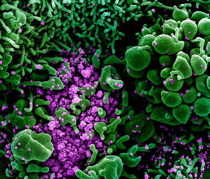 Colorized scanning electron micrograph of an apoptotic cell (green) heavily infected with SARS-COV-2 virus particles (purple), isolated from a patient sample. Image captured and color-enhanced at the NIAID Integrated Research Facility (IRF) in Fort Detrick, Maryland. / Credit: NIAID