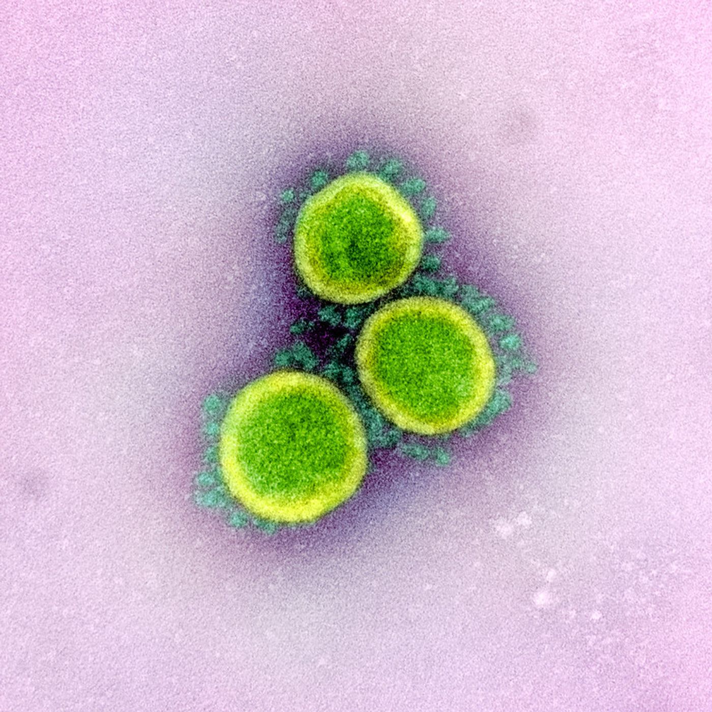  Transmission electron micrograph of SARS-CoV-2 virus particles, isolated from a patient. Image captured and color-enhanced at the NIAID Integrated Research Facility (IRF) in Fort Detrick, Maryland.     Credit: National Institute of Allergy and Infectious Diseases, NIH