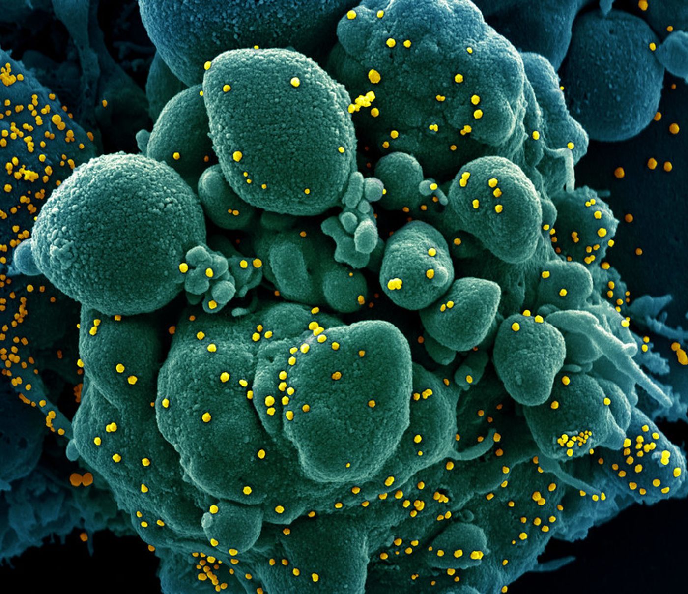 infected with SARS-COV-2 virus particles (yellow), isolated from a patient sample. Image captured at the NIAID Integrated Research Facility (IRF) in Fort Detrick, Maryland.