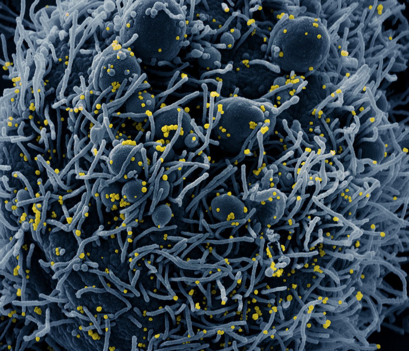 Colorized scanning electron micrograph of an apoptotic cell (blue) infected with SARS-COV-2 virus particles (yellow), isolated from a patient sample. Image captured at the NIAID Integrated Research Facility (IRF) in Fort Detrick, Maryland. Credit: NIAID