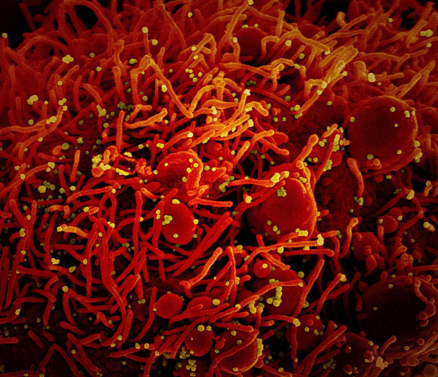 Colorized scanning electron micrograph of an apoptotic cell (red) infected with SARS-COV-2 virus particles (yellow), isolated from a patient sample. Image captured at the NIAID Integrated Research Facility (IRF) in Fort Detrick, Maryland. / Credit: NIAID