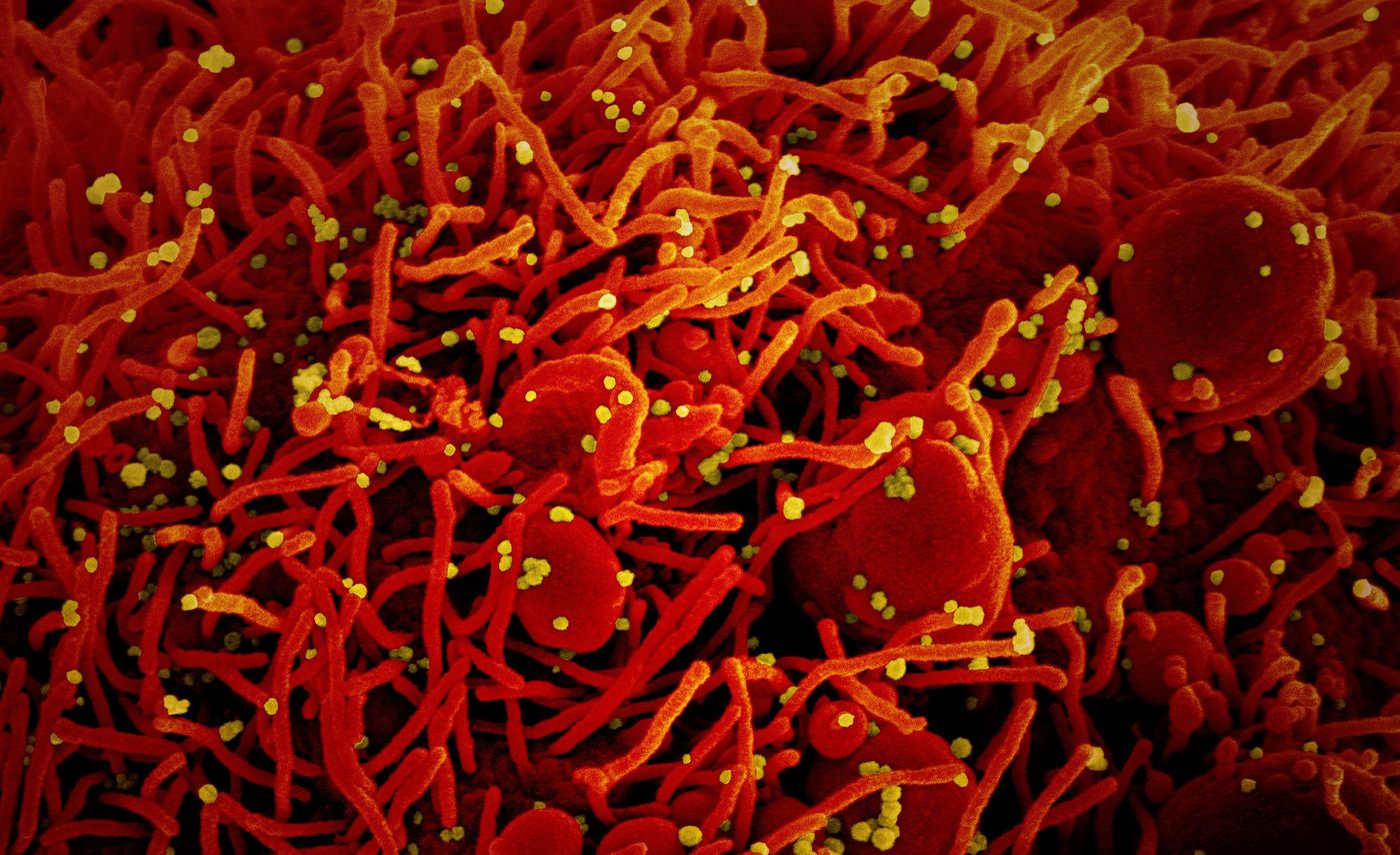 Colorized scanning electron micrograph of an apoptotic cell (red) infected with SARS-COV-2 virus particles (yellow), isolated from a patient sample. Image captured at the NIAID Integrated Research Facility (IRF) in Fort Detrick, Maryland./Credit: NIAID