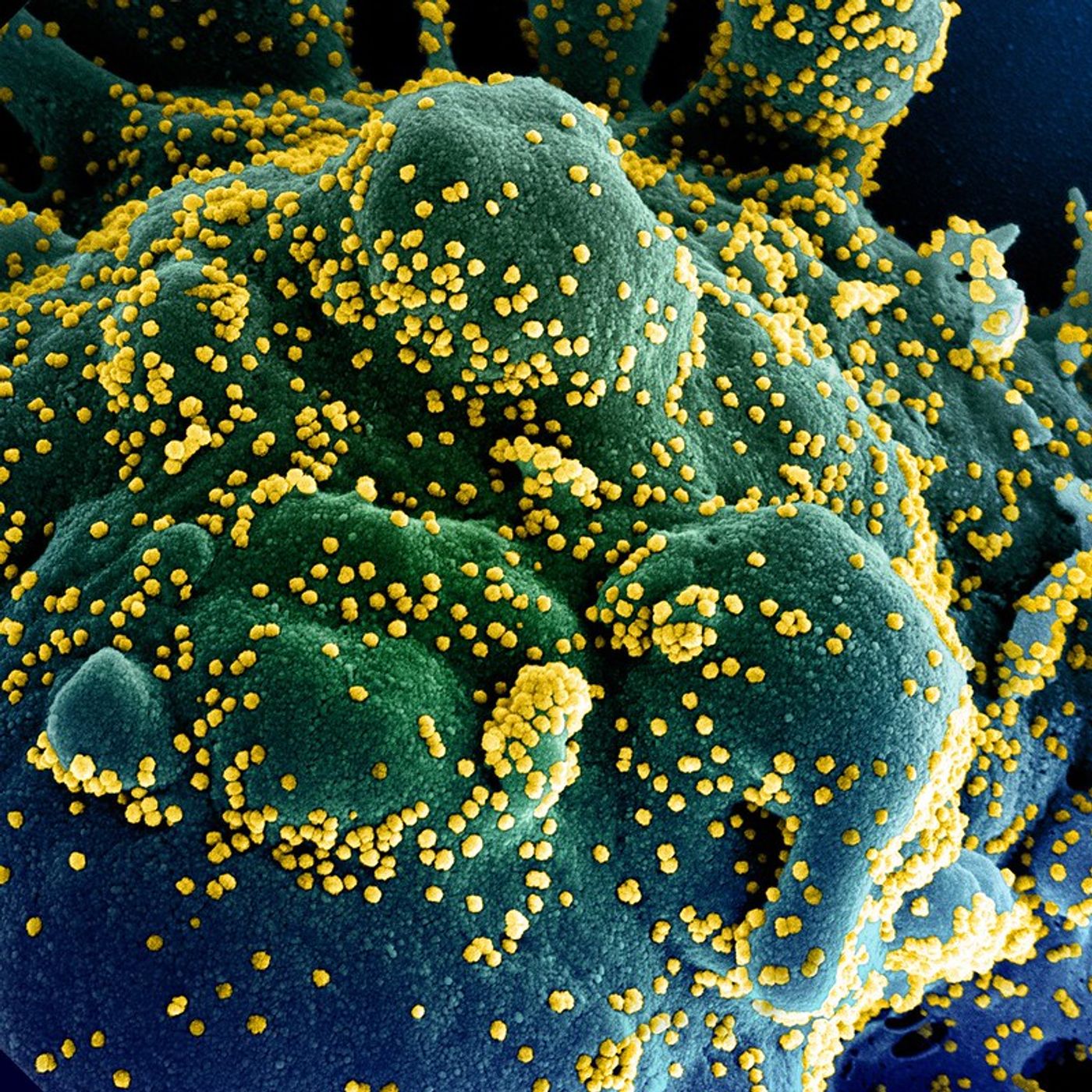 Colorized scanning electron micrograph of an apoptotic cell (blue/green) heavily infected with SARS-COV-2 virus particles (yellow), isolated from a patient sample. Image captured at the NIAID Integrated Research Facility (IRF) in Fort Detrick, Maryland. / Credit: NIAID