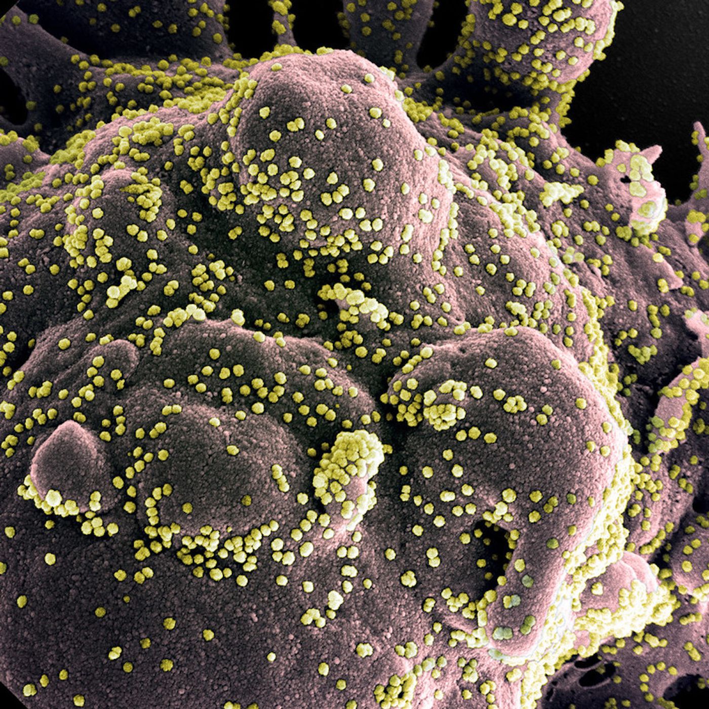 Colorized scanning electron micrograph of an apoptotic cell (gray) heavily infected with SARS-COV-2 virus particles (yellow), isolated from a patient sample. Image captured at the NIAID Integrated Research Facility (IRF) in Fort Detrick, Maryland. / Credit: NIAID