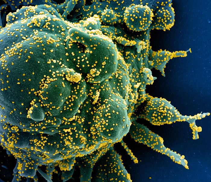 Colorized scanning electron micrograph of an apoptotic cell (green) heavily infected with SARS-COV-2 virus particles (yellow), isolated from a patient sample. Image captured at the NIAID Integrated Research Facility (IRF) in Fort Detrick, Maryland. Credit: NIAID
