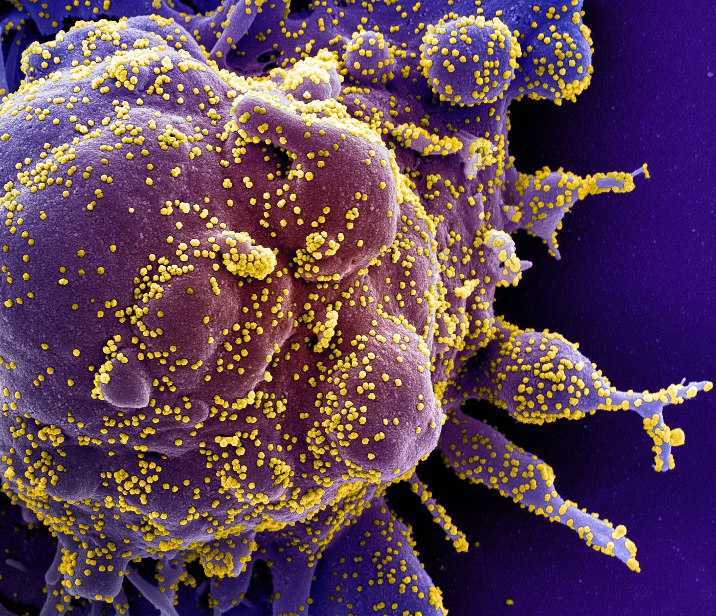 Colorized scanning electron micrograph of an apoptotic cell (purple) heavily infected with SARS-COV-2 virus particles (yellow), isolated from a patient sample. Image captured at the NIAID Integrated Research Facility (IRF) in Fort Detrick, Maryland. / Credit: NIAID