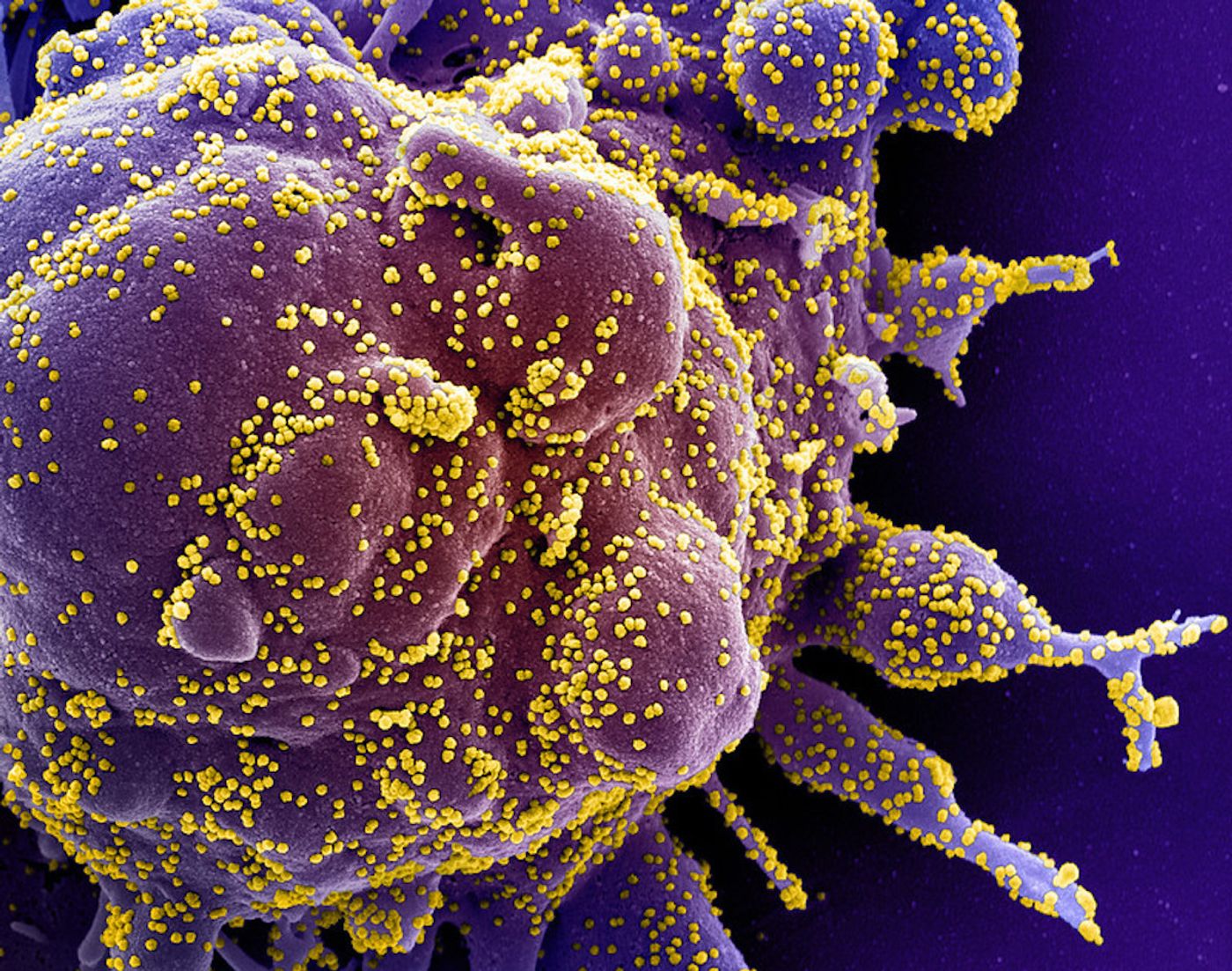 Colorized scanning electron micrograph of an apoptotic cell (purple) heavily infected with SARS-COV-2 virus particles (yellow), isolated from a patient sample. Image captured at the NIAID Integrated Research Facility (IRF) in Fort Detrick, Maryland. / Credit: NIAID