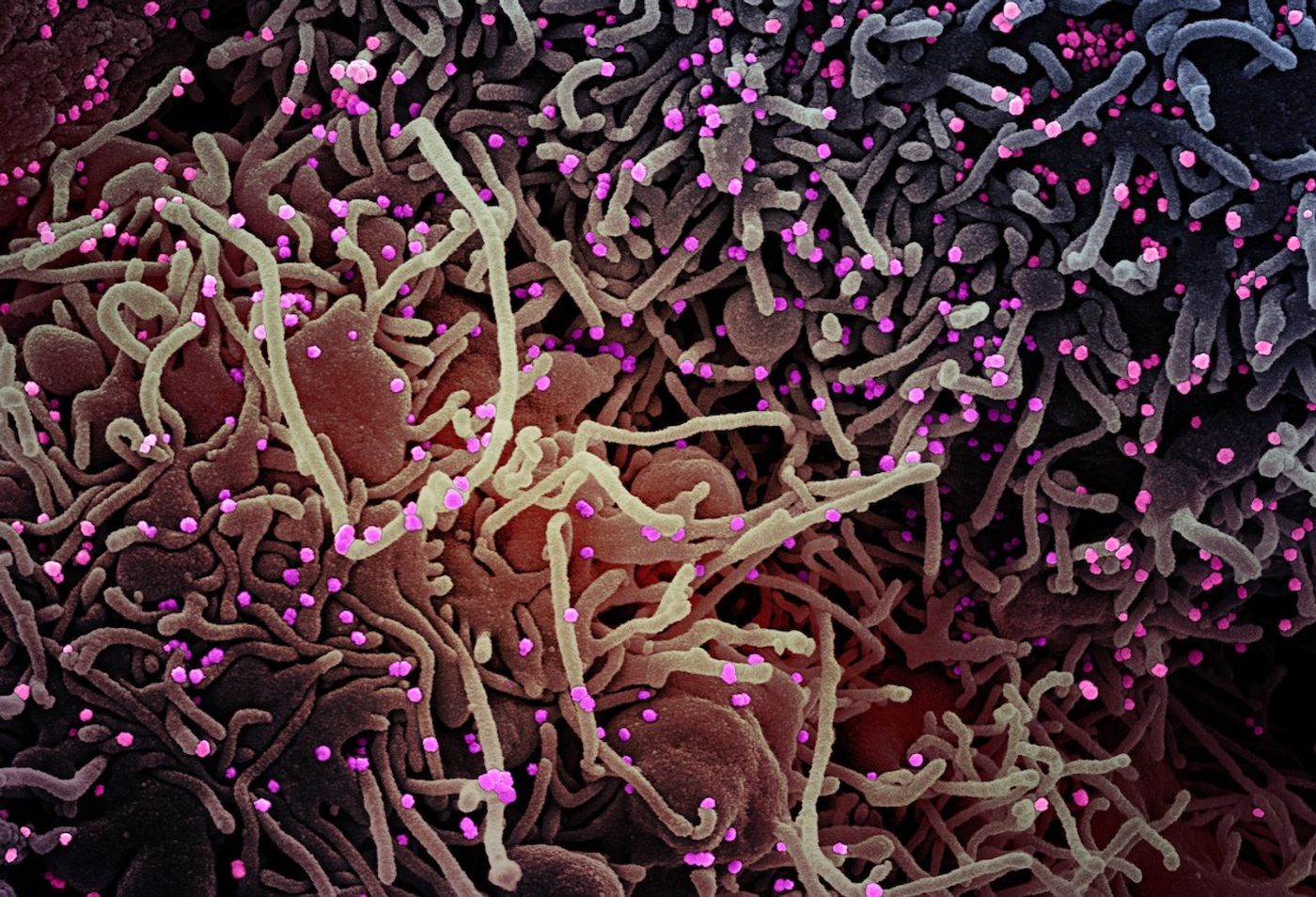 Colorized scanning electron micrograph of a VERO E6 cell (purple) exhibiting elongated cell projections and signs of apoptosis, after infection with SARS-COV-2 virus particles (pink), which were isolated from a patient sample. Image captured at the NIAID Integrated Research Facility (IRF) in Fort Detrick, Maryland. Credit: NIAID