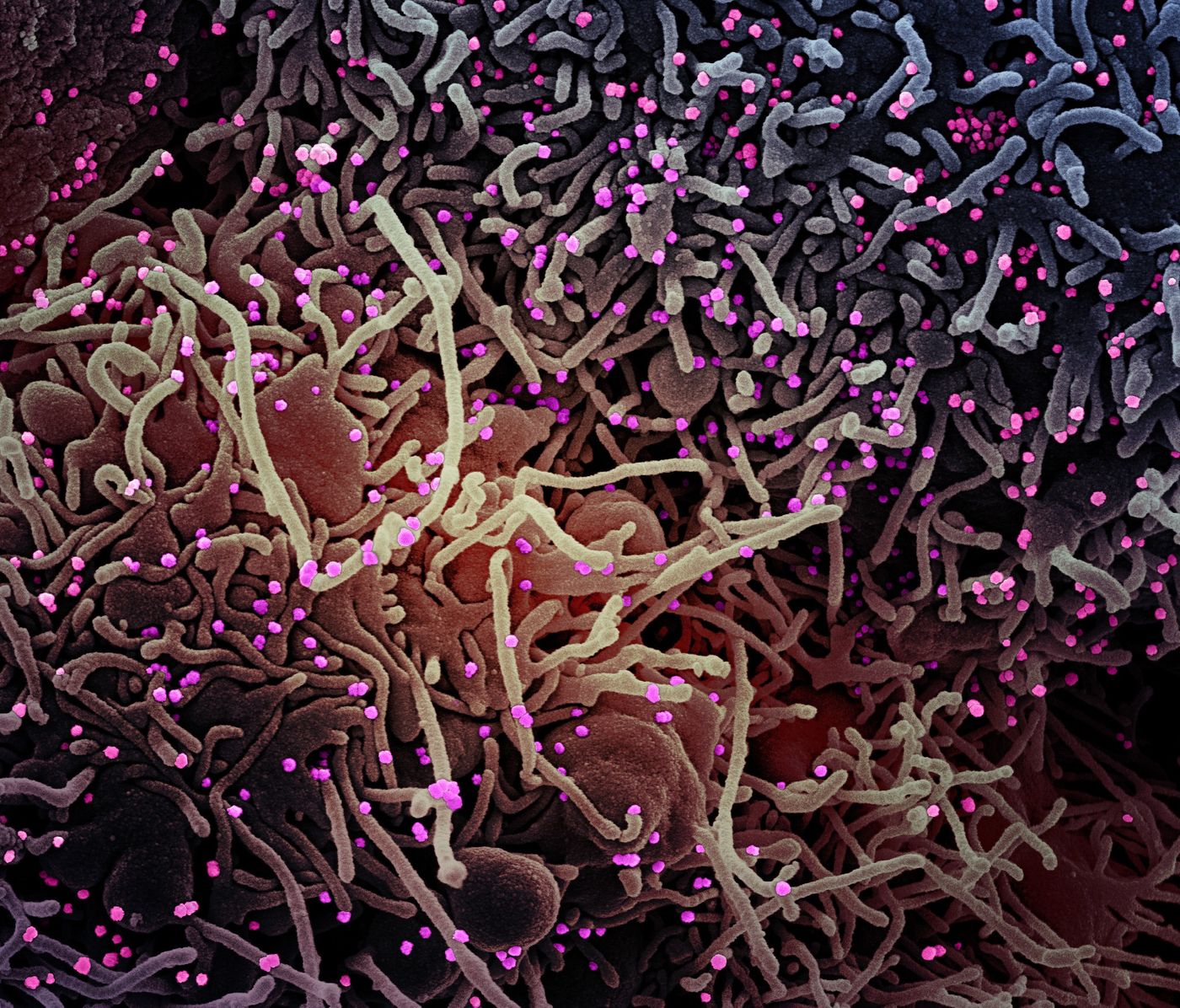 Colorized scanning electron micrograph of a VERO E6 cell (purple) exhibiting elongated cell projections and signs of apoptosis, after infection with SARS-COV-2 virus particles (pink), which were isolated from a patient sample. Image captured at the NIAID Integrated Research Facility (IRF) in Fort Detrick, Maryland. / Credit: NIAID