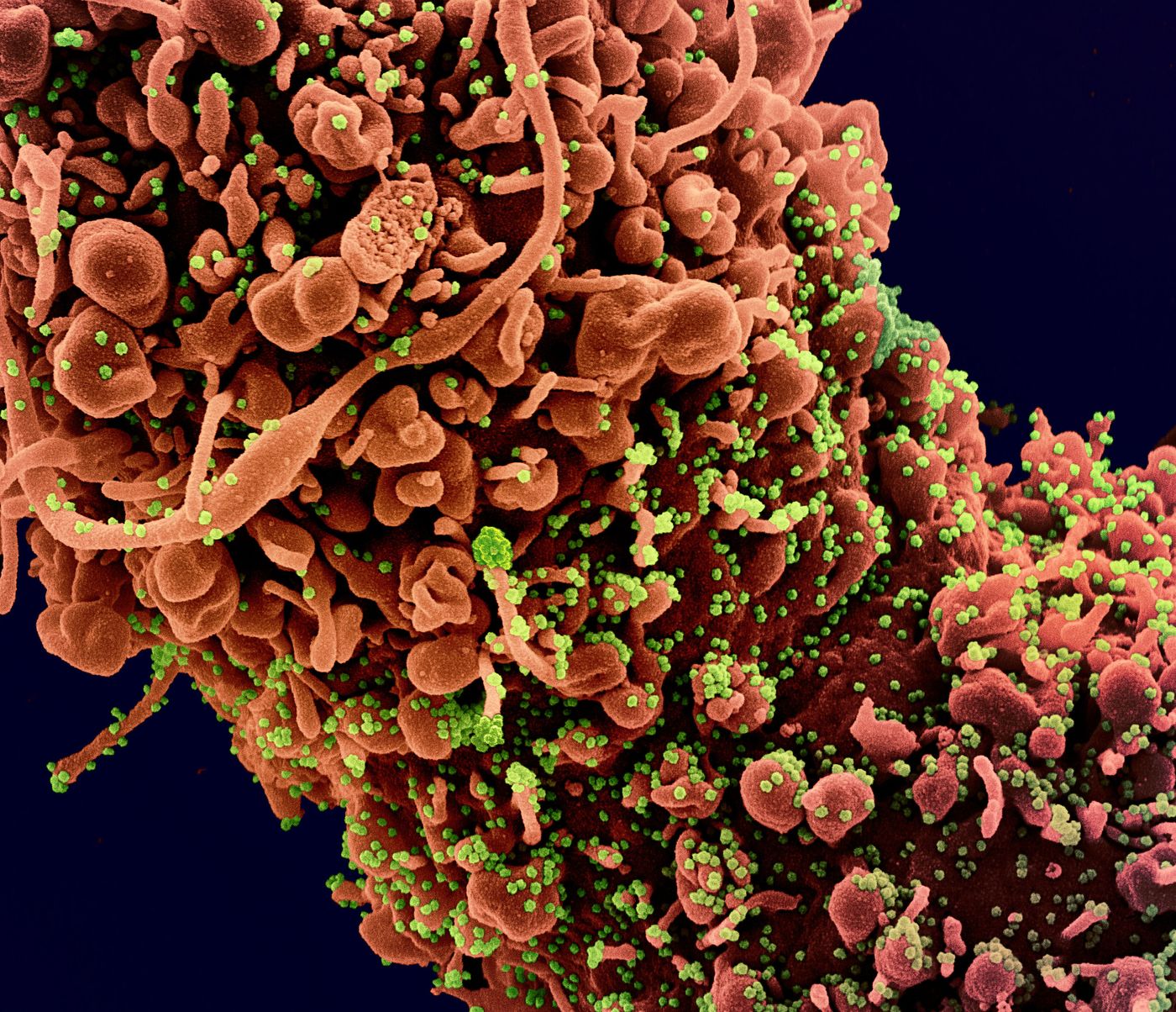 Colorized scanning electron micrograph of a cell showing morphological signs of apoptosis, infected with SARS-COV-2 virus particles (green), isolated from a patient sample. Image captured at the NIAID Integrated Research Facility (IRF) in Fort Detrick, Maryland. / Credit: NIAID