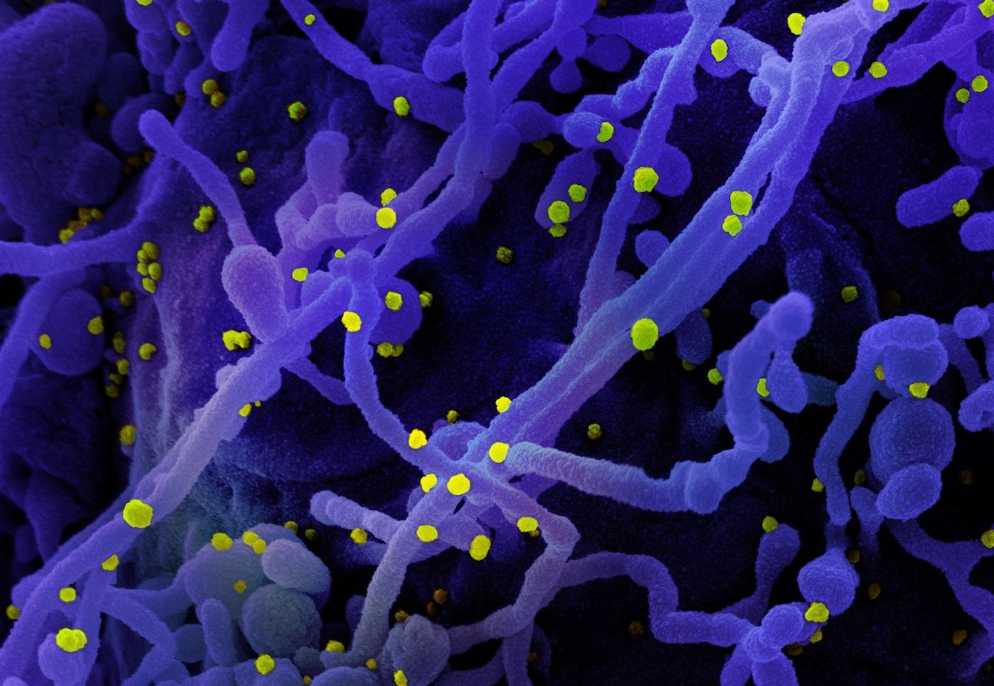 Cropped from a colorized scanning electron micrograph of a cell (purple) infected with SARS-CoV-2 virus particles (yellow), isolated from a patient sample. Image captured at the NIAID Integrated Research Facility (IRF) in Fort Detrick, Maryland. Credit: NIAID