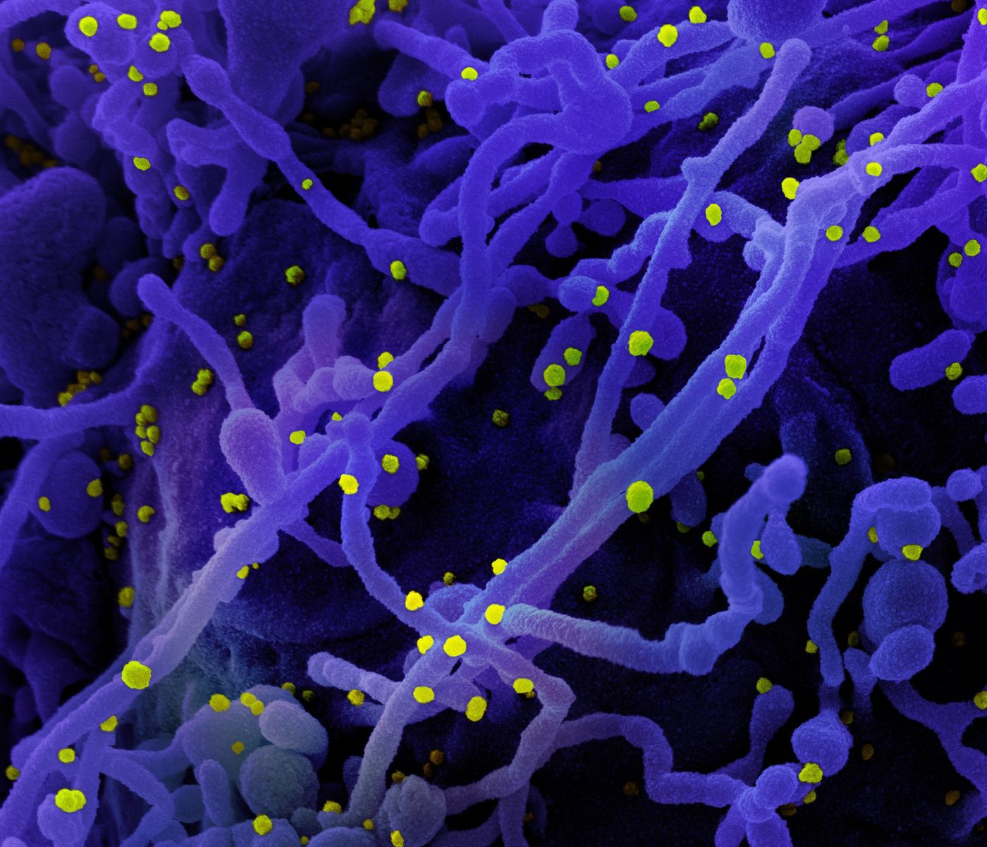 Colorized scanning electron micrograph of a cell (purple) infected with SARS-CoV-2 virus particles (yellow), isolated from a patient sample. Image captured at the NIAID Integrated Research Facility (IRF) in Fort Detrick, Maryland. Credit: NIAID