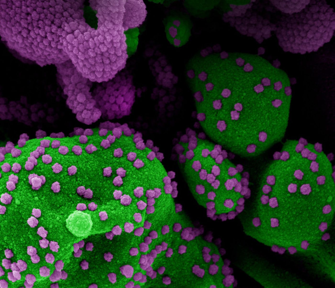 Colorized scanning electron micrograph of an apoptotic cell (green) heavily infected with SARS-COV-2 virus particles (purple), isolated from a patient sample. Image from the NIAID Integrated Research Facility (IRF) in Fort Detrick, Maryland. / Credit: NIAID