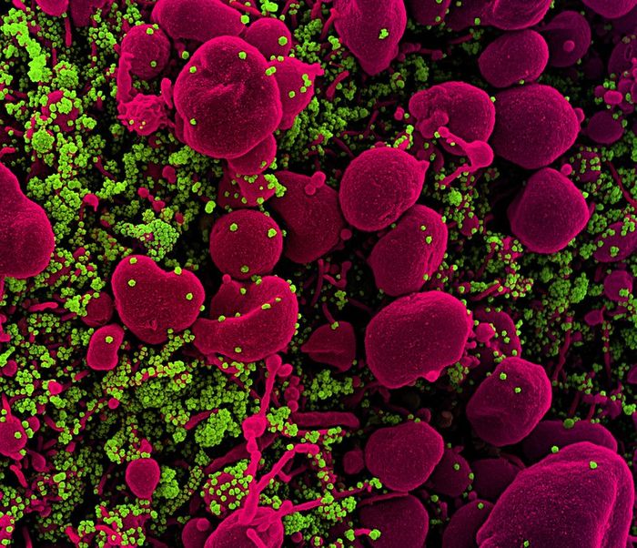 Colorized scanning electron micrograph of an apoptotic cell (pink) heavily infected with SARS-COV-2 virus particles (green), isolated from a patient sample. Image captured at the NIAID Integrated Research Facility (IRF) in Fort Detrick, Maryland. / Credit: NIAID