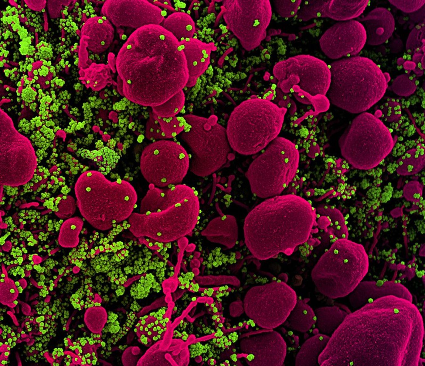 Colorized scanning electron micrograph of an apoptotic cell (pink) heavily infected with SARS-COV-2 virus particles (green), isolated from a patient sample. Image captured at the NIAID Integrated Research Facility (IRF) in Fort Detrick, Maryland. / Credit: NIAID