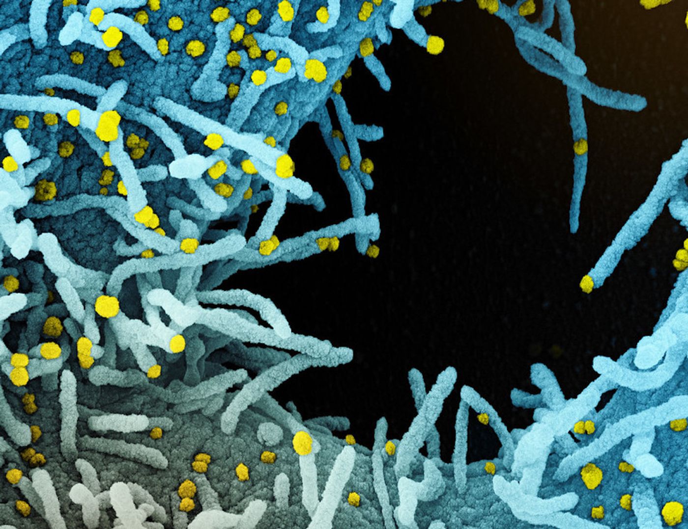 Colorized scanning electron micrograph of a cell heavily infected with SARS-CoV-2 virus particles (yellow), isolated from a patient sample. The black area in the image is extracellular space between the cells. Image captured at the NIAID Integrated Research Facility (IRF) in Fort Detrick, Maryland. Credit: (Modified from) NIAID