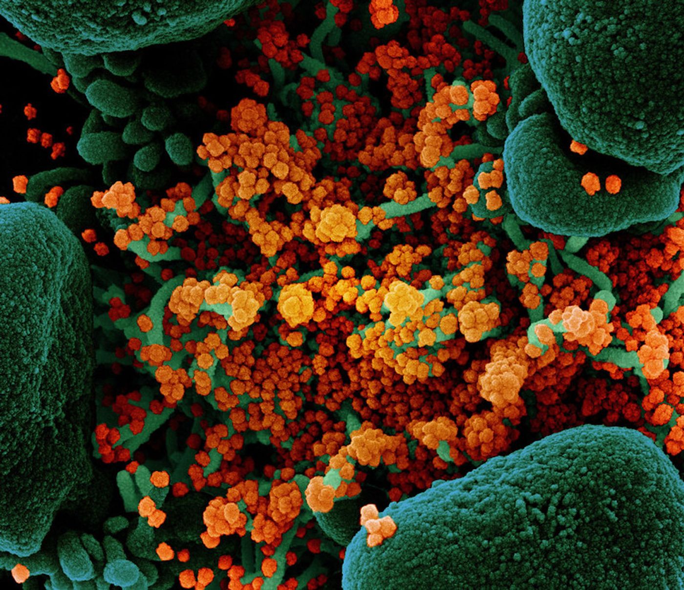 Colorized scanning electron micrograph of an apoptotic cell (green) heavily infected with SARS-COV-2 virus particles (orange), isolated from a patient sample. Image at the NIAID Integrated Research Facility (IRF) in Fort Detrick, Maryland. / Credit: NIAID