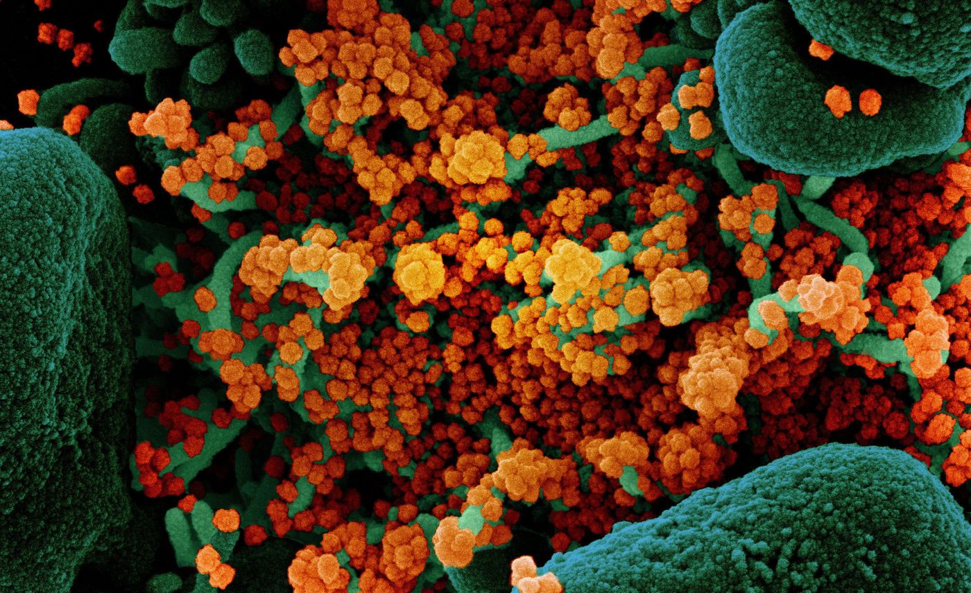 Cropped from a colorized scanning electron micrograph of an apoptotic cell (green) heavily infected with SARS-CoV-2 virus particles (orange), isolated from a patient sample. Image captured at the NIAID Integrated Research Facility (IRF) in Fort Detrick, Maryland. / Credit: NIAID