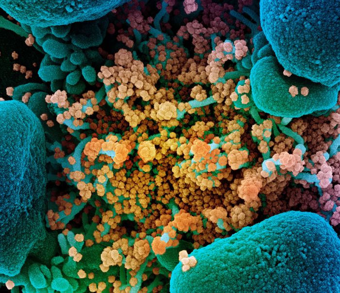Novel Coronavirus SARS-CoV-2  Colorized scanning electron micrograph of an apoptotic cell (blue) heavily infected with SARS-CoV-2 virus particles (yellow), isolated from a patient sample. Image captured at the NIAID Integrated Research Facility (IRF) in Fort Detrick, Maryland. Credit: NIAID