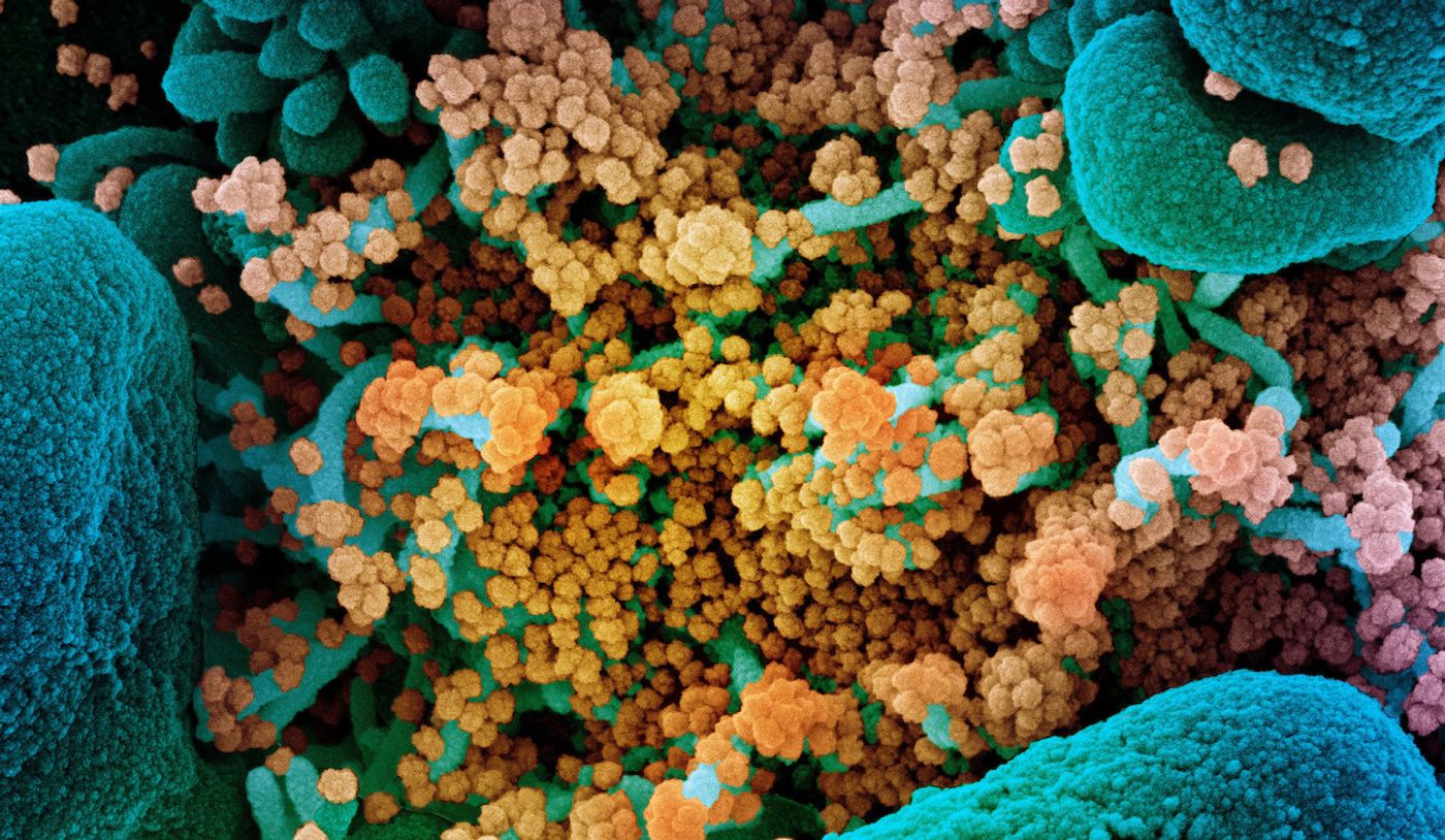 Colorized scanning electron micrograph of an apoptotic cell (blue) heavily infected with SARS-COV-2 virus particles (yellow), isolated from a patient sample. Image captured at the NIAID Integrated Research Facility (IRF) in Fort Detrick, Maryland. / Credit: NIAID