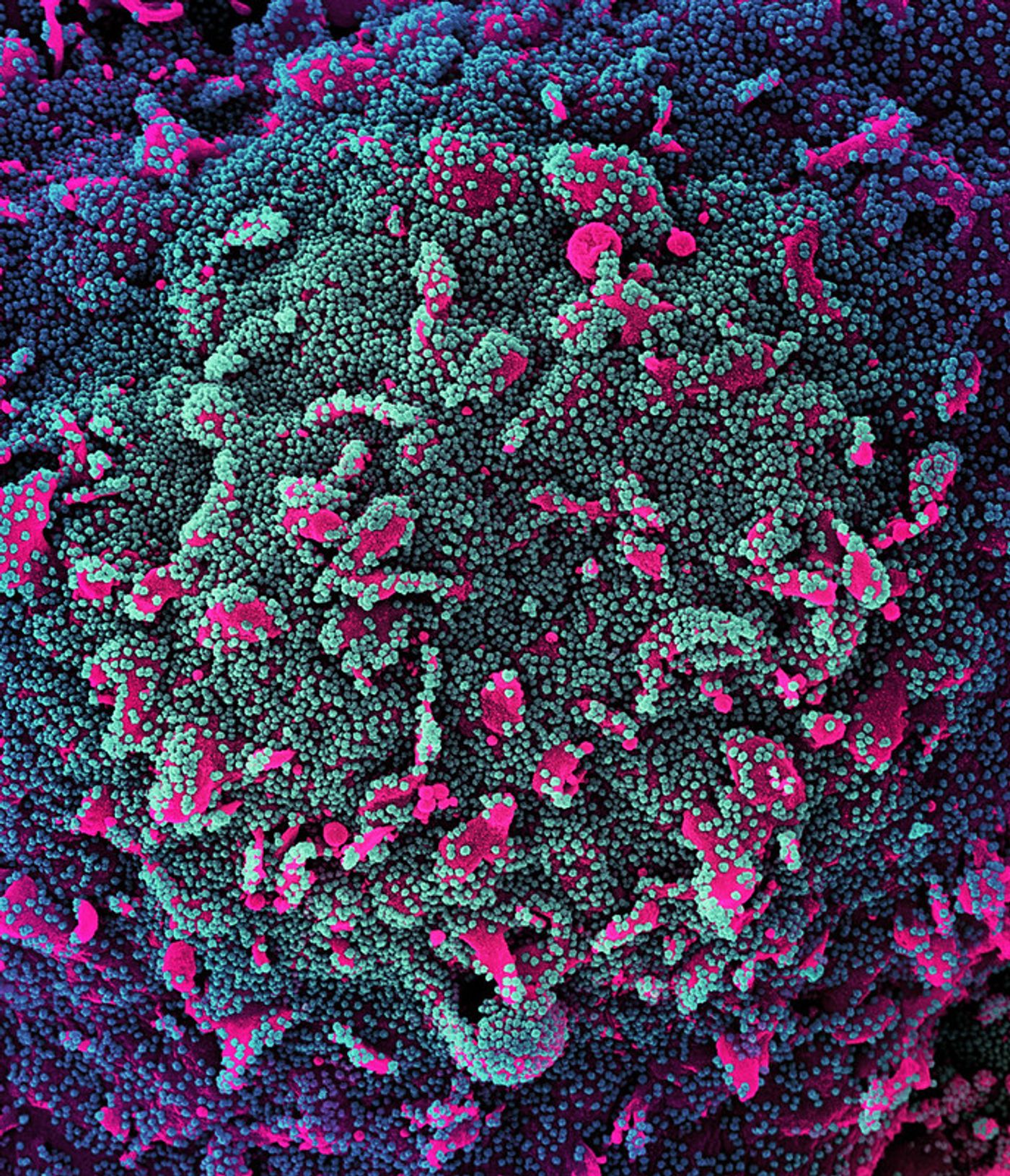   Colorized scanning electron micrograph of a cell (pink) heavily infected with SARS-CoV-2 virus particles (teal and purple), isolated from a patient sample. Image captured at the NIAID Integrated Research Facility (IRF) in Fort Detrick, Maryland. Credit: NIAID/NIH
