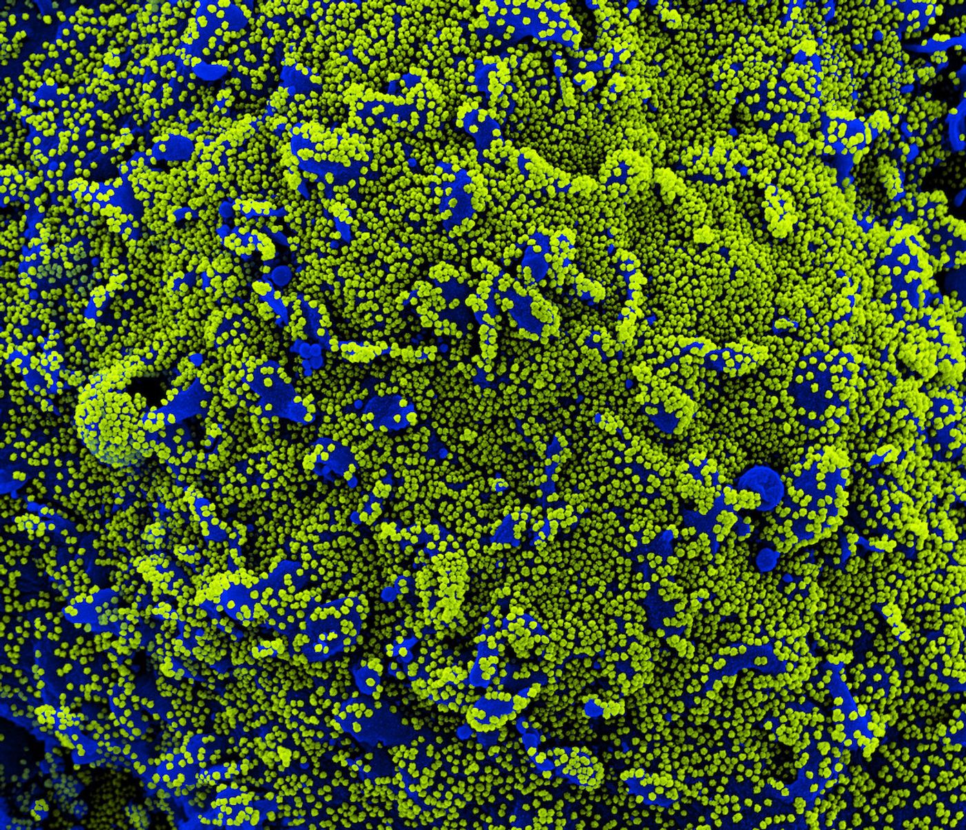 Colorized scanning electron micrograph of a cell (blue) heavily infected with SARS-CoV-2 virus particles (green), isolated from a patient sample. Image captured at the NIAID Integrated Research Facility (IRF) in Fort Detrick, Maryland. Credit: NIAID 