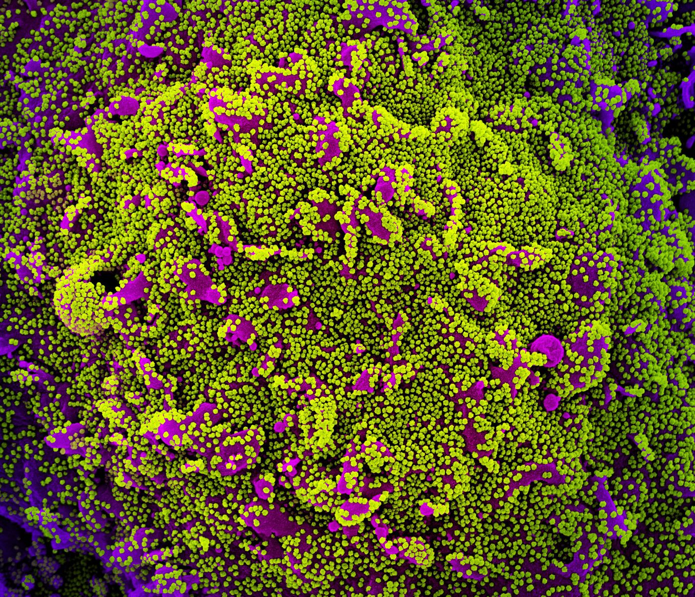 Colorized scanning electron micrograph of a cell (purple) heavily infected with SARS-CoV-2 virus particles, isolated from a patient sample. Image captured at the NIAID Integrated Research Facility (IRF) in Fort Detrick, Maryland. Credit: NIAID