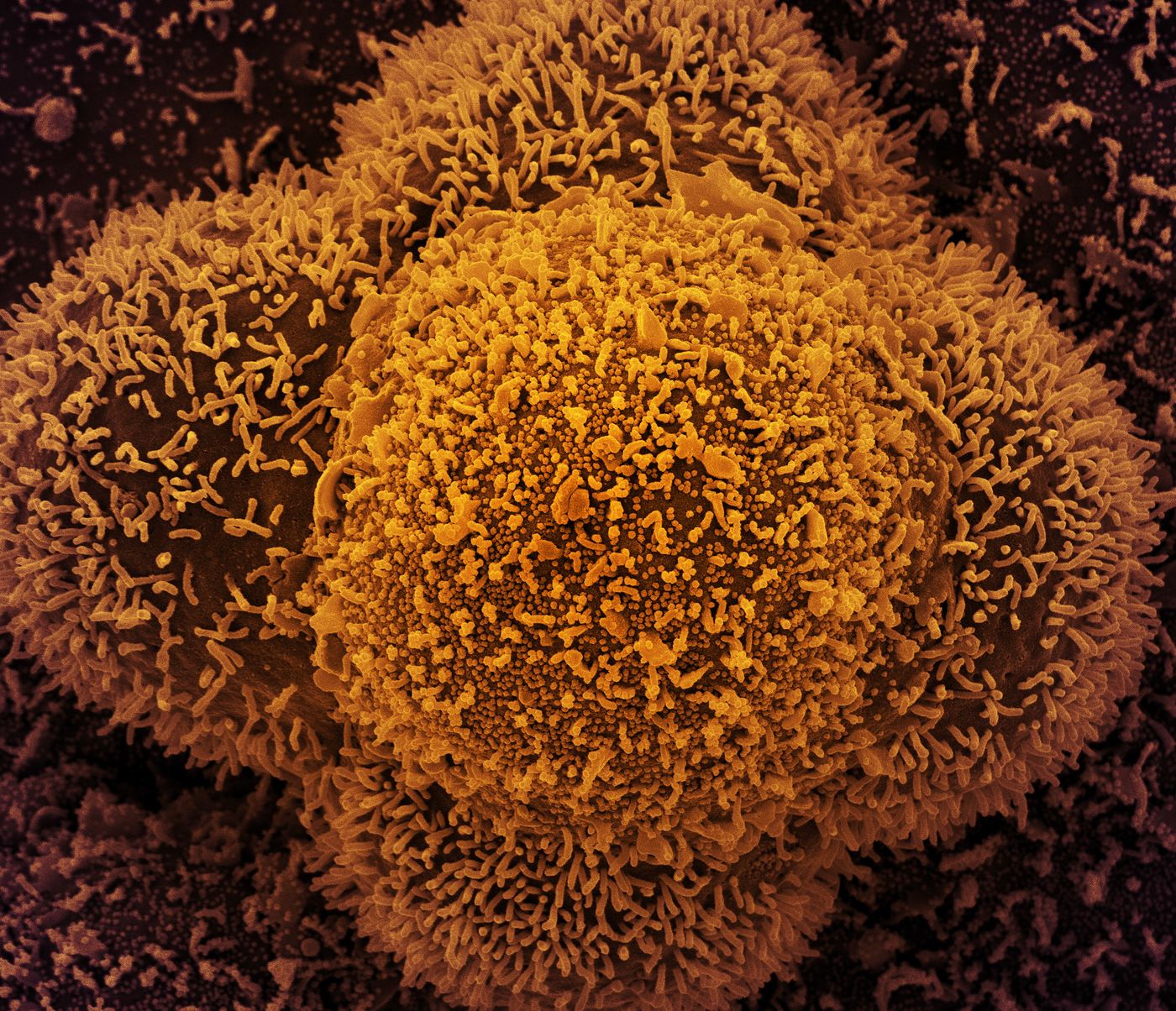 CCL-81 cells heavily infected with SARS-CoV-2 virus particles. The small spherical structures in the center of the image are SARS-CoV-2 virus particles. The string-like protrusions extending from the cells are cell projections or pseudopodium. Image captured at the NIAID Integrated Research Facility (IRF) in Fort Detrick, Maryland. / Credit: NIAID
