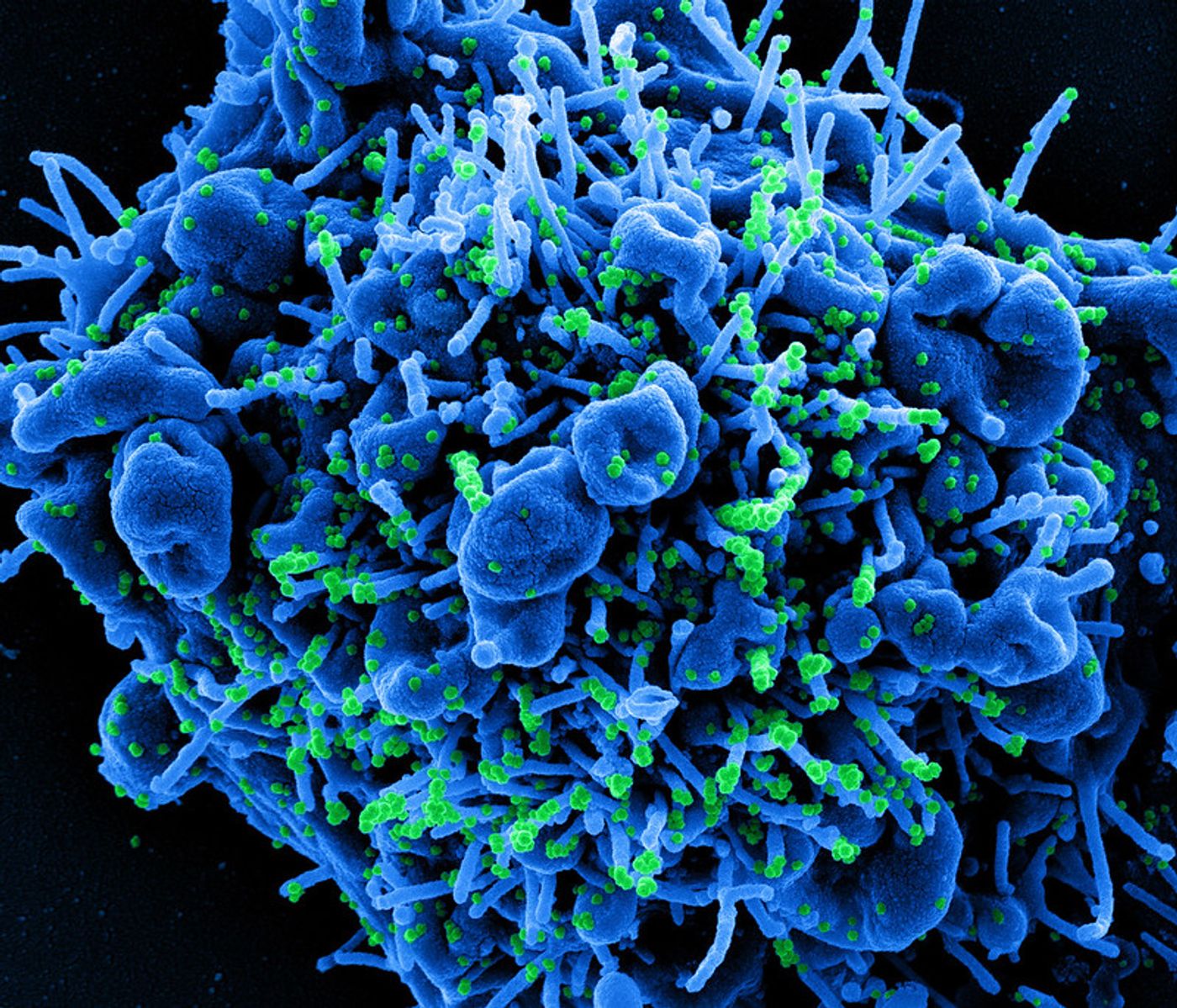 Colorized scanning electron micrograph of an apoptotic cell (blue) infected with SARS-COV-2 virus particles (green), isolated from a patient sample. Image captured at the NIAID Integrated Research Facility (IRF) in Fort Detrick, Maryland. Credit: NIAID