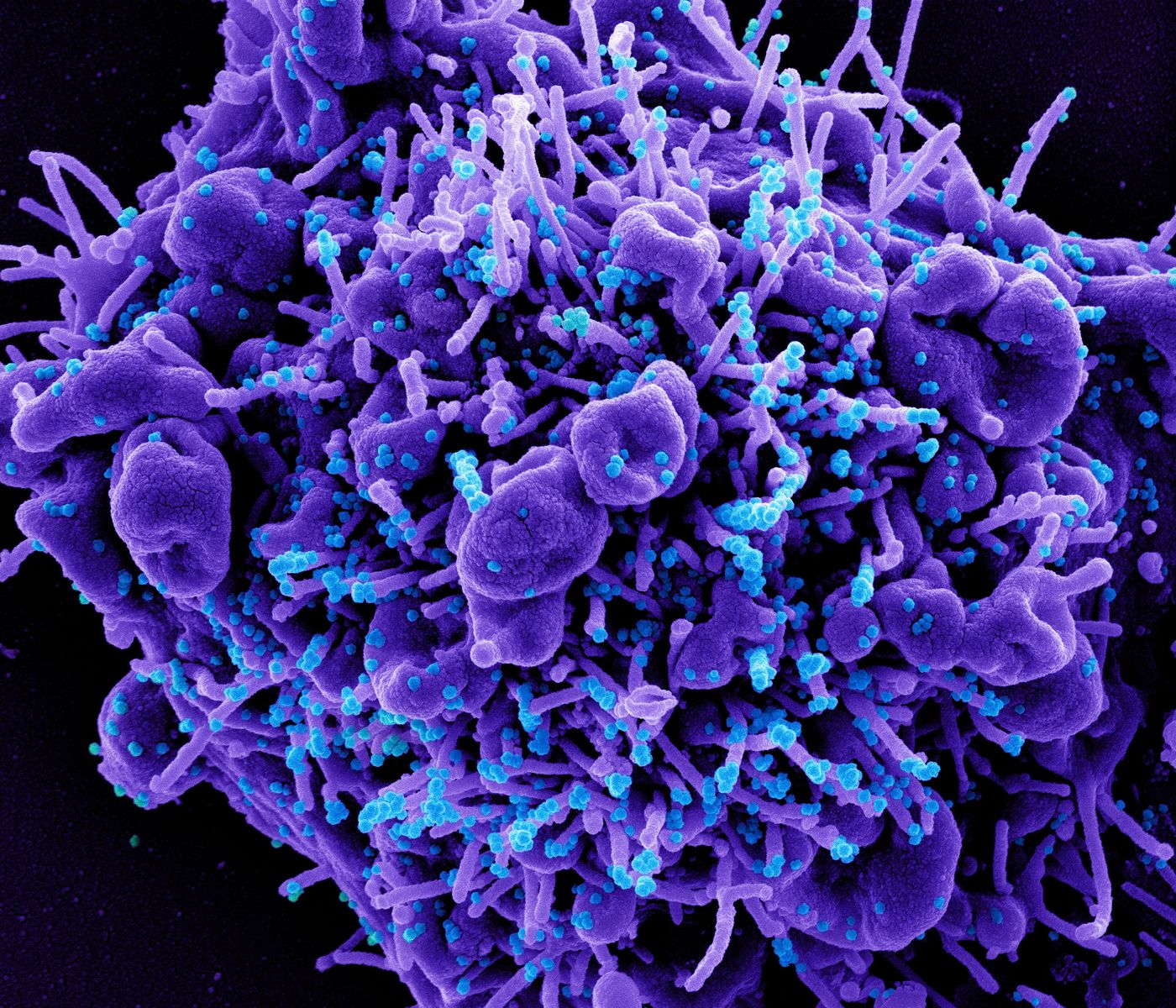 Colorized scanning electron micrograph of an apoptotic cell (purple) infected with SARS-COV-2 virus particles (blue), isolated from a patient sample. Image captured at the NIAID Integrated Research Facility (IRF) in Fort Detrick, Maryland. Credit: NIAID
