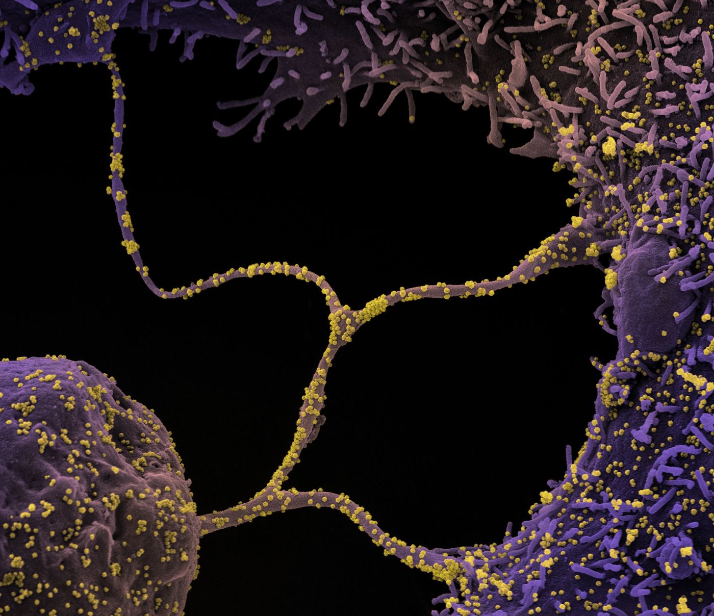 Colorized scanning electron micrograph of CCL-81 cells (purple) infected with SARS-CoV-2 virus particles (yellow) from a patient sample. The cell protrusions are filapodia; they extend from infected cells, attach to neighbors, and transport infectious virus particles. Credit: NIAID Integrated Research Facility (IRF) in Fort Detrick, Maryland