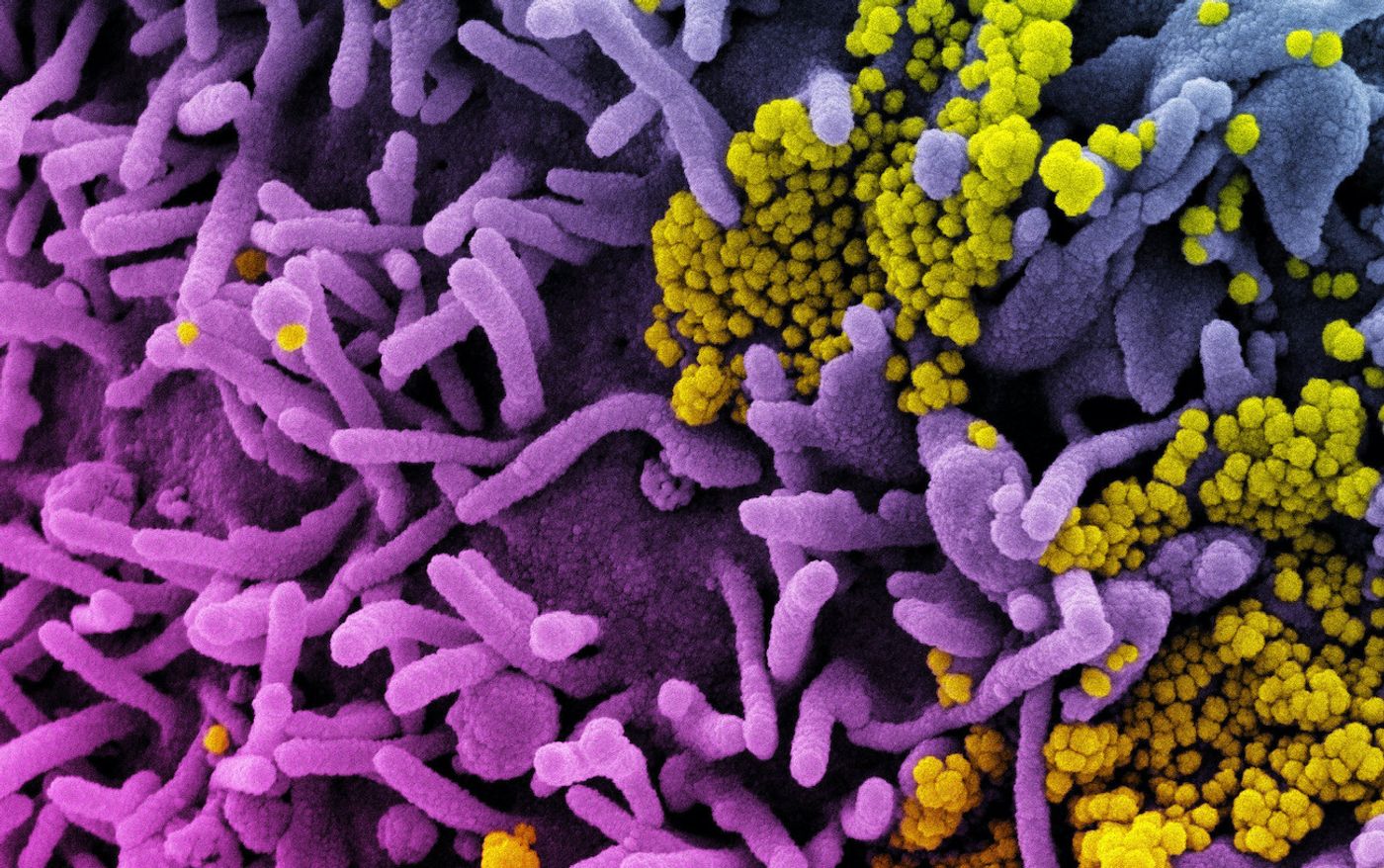 Colorized scanning electron micrograph of a cell (purple) infected with SARS-CoV-2 virus particles (yellow), isolated from a patient sample. Image captured at the NIAID Integrated Research Facility (IRF) in Fort Detrick, Maryland. Credit: NIAID