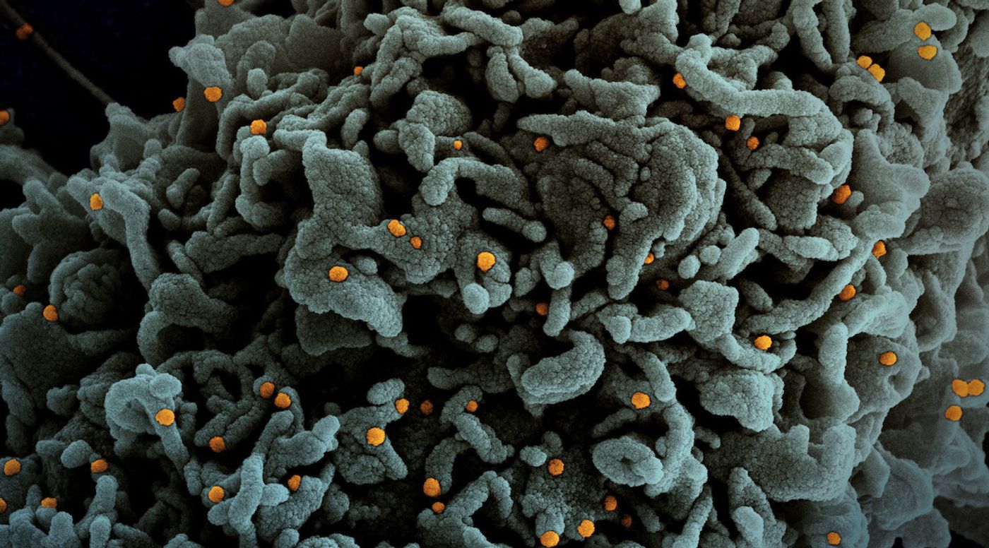 Colorized scanning electron micrograph of a cell (teal) infected with UK B.1.1.7 variant SARS-CoV-2 virus particles (orange), isolated from a patient sample. Image captured at the NIAID Integrated Research Facility (IRF) in Fort Detrick, Maryland. Credit: NIAID